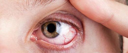 眼球有红血丝的原因