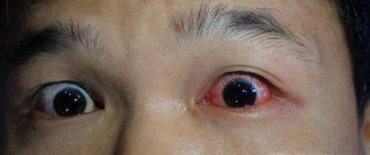 眼球有红血丝的原因
