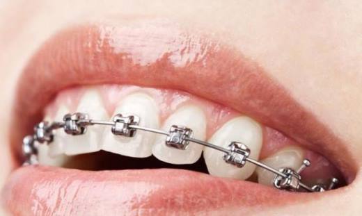 矫正牙齿期间 你需要注意些什么？