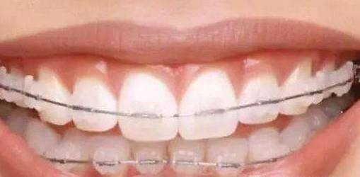 自锁牙套第五次复诊 带牙套掉了托槽怎么办？