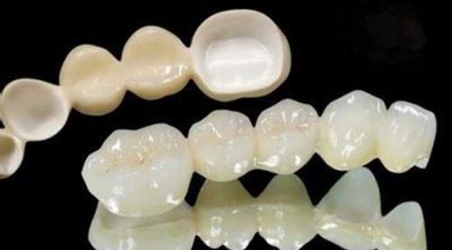 种植牙和烤瓷牙区别 哪种牙齿更好一些各有优劣