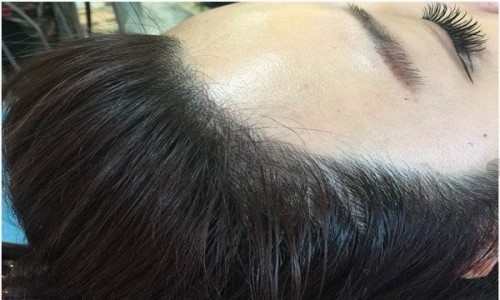 纹发际线的危害有哪些 纹发际线会留下隐性的疤痕
