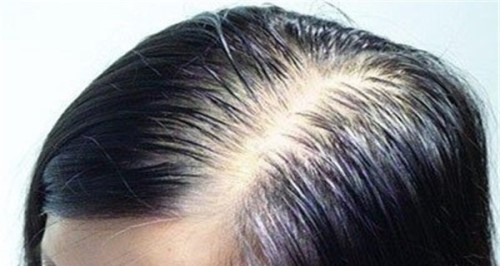 掉头发是因为什么？？多种因素可能导致掉头发