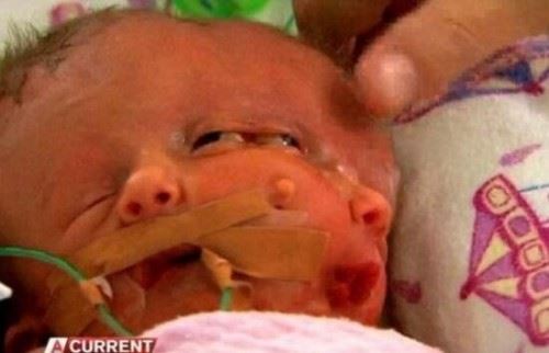 澳大利亚怪婴之谜 女子产下双面婴儿两张脸/一个身体