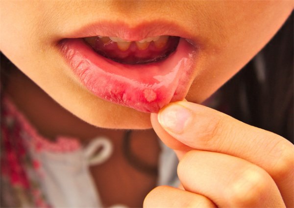 口腔溃疡有什么症状?口腔溃疡的原因是什么